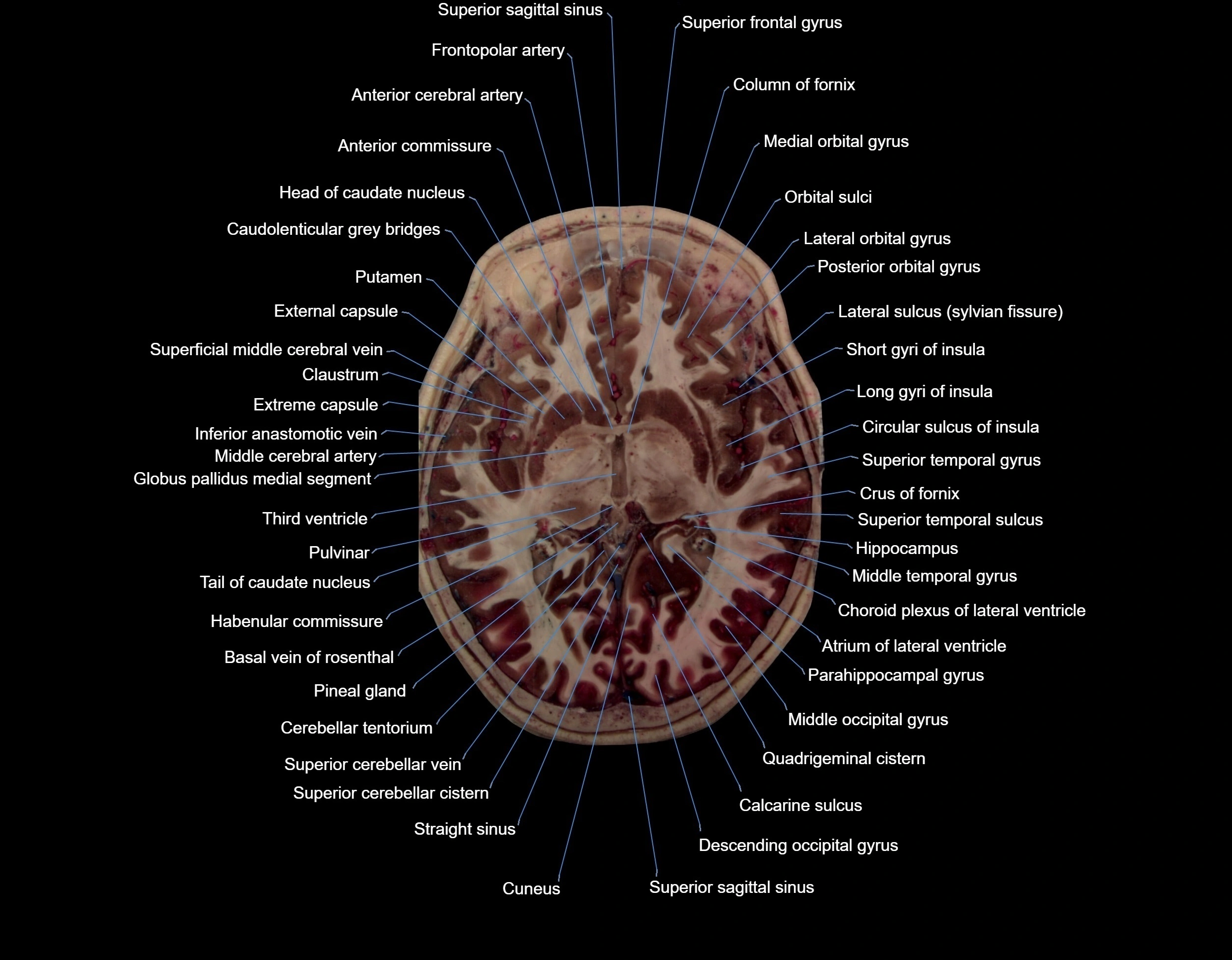 MRI Brain axial cross sectional radiology anatomy 3T image  -img-000040.webp